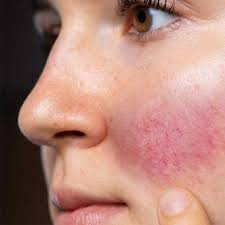 Dealing with rosacea